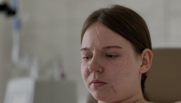 Львівські пластичні хірурги відновлюють обличчя 20-річній жительці Луганщини